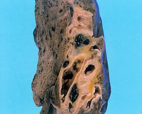 正常な肺切片標本 